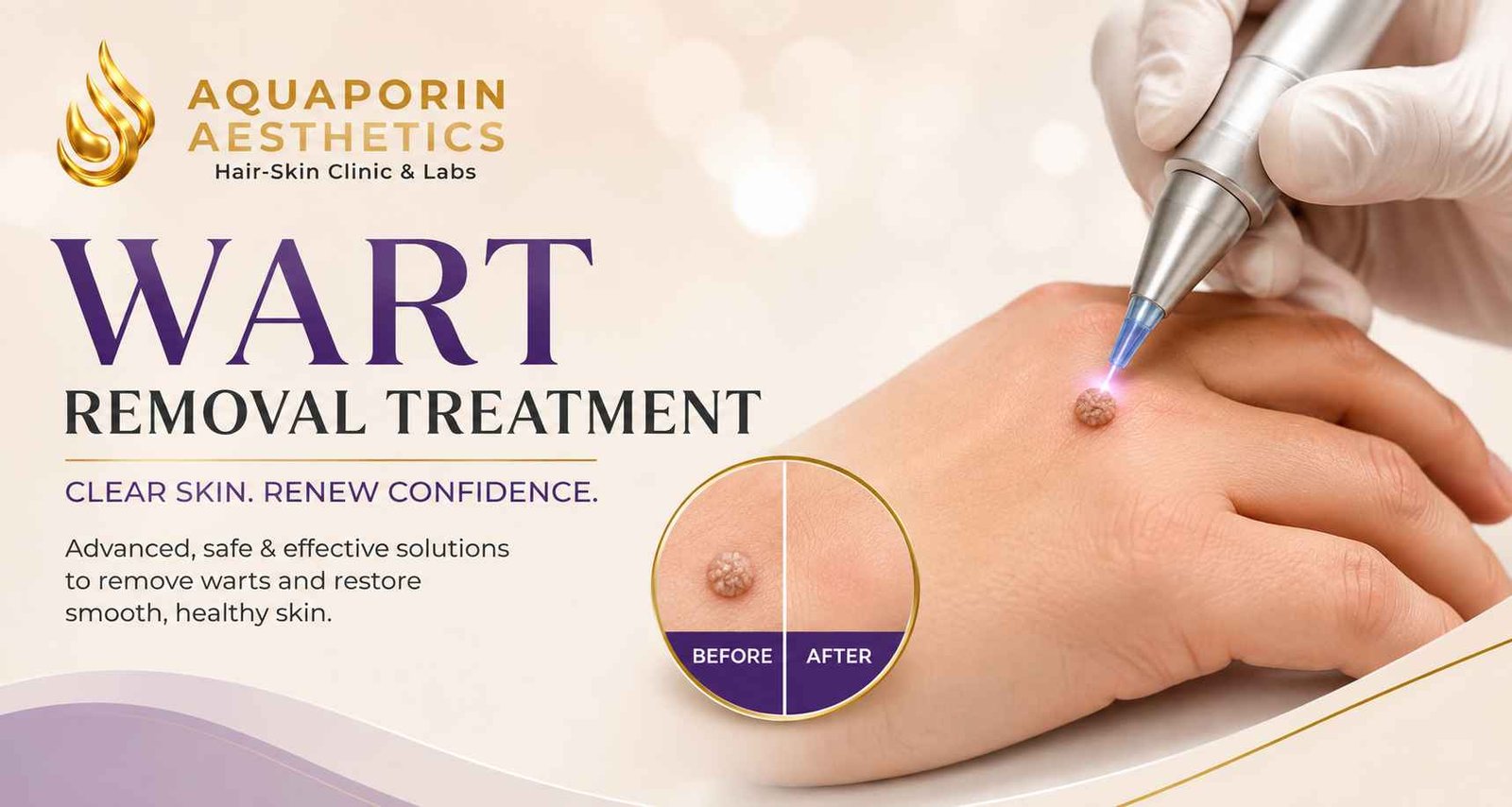Wart Removal